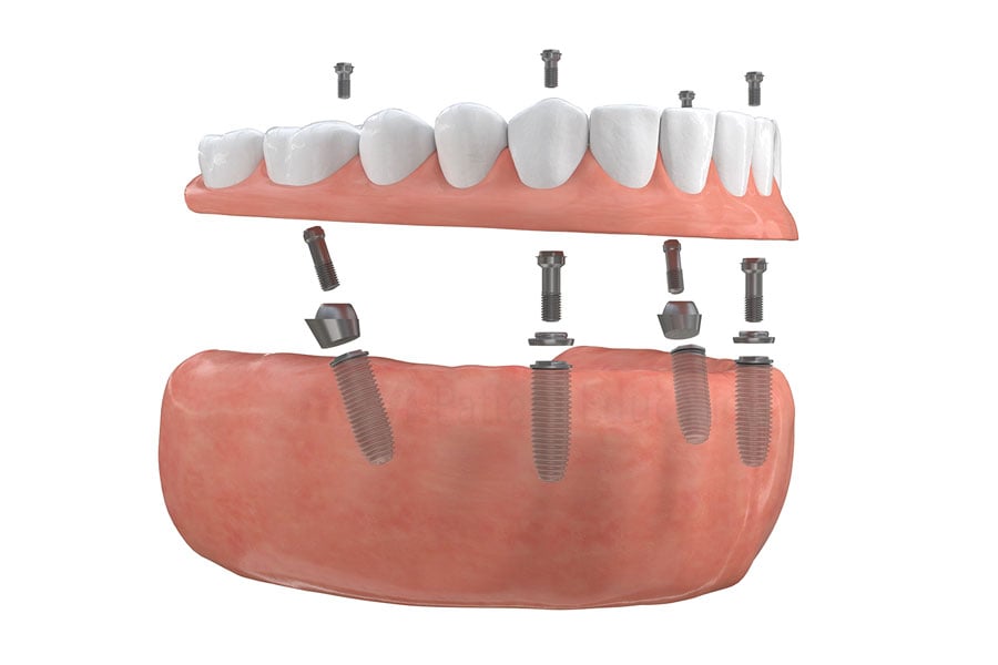 Are you missing all your teeth and would like to get beautiful smile quickly and permanently? Contact us to see if you are a candidate for full mouth restoration with dental implants near Hinsdale, IL. Full Mouth Restoration in Hinsdale, IL