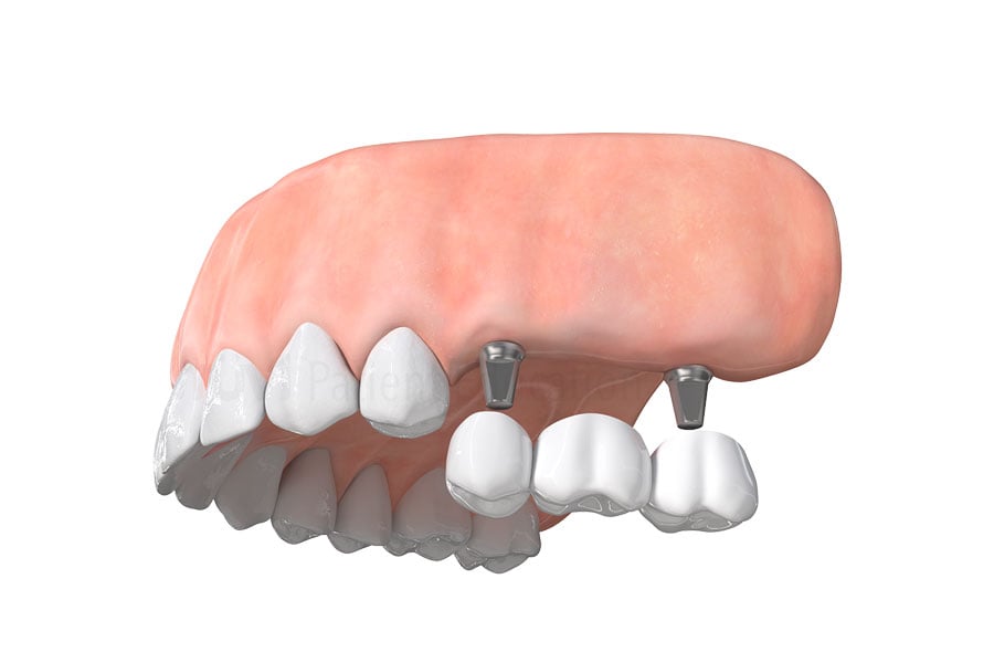 Let Dr. Alina Huff, recommended family dentist in Hinsdale IL, help you replace missing teeth with dental implants near 60521. Dental Implant Bridge in Hinsdale, IL