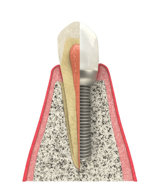 Schedule a dental consultation with Dr. Alina Huff, well-qualified cosmetic dentist in Hinsdale IL, to restore your teeth with dental implants near 60521. Dental Implants in Hinsdale, IL