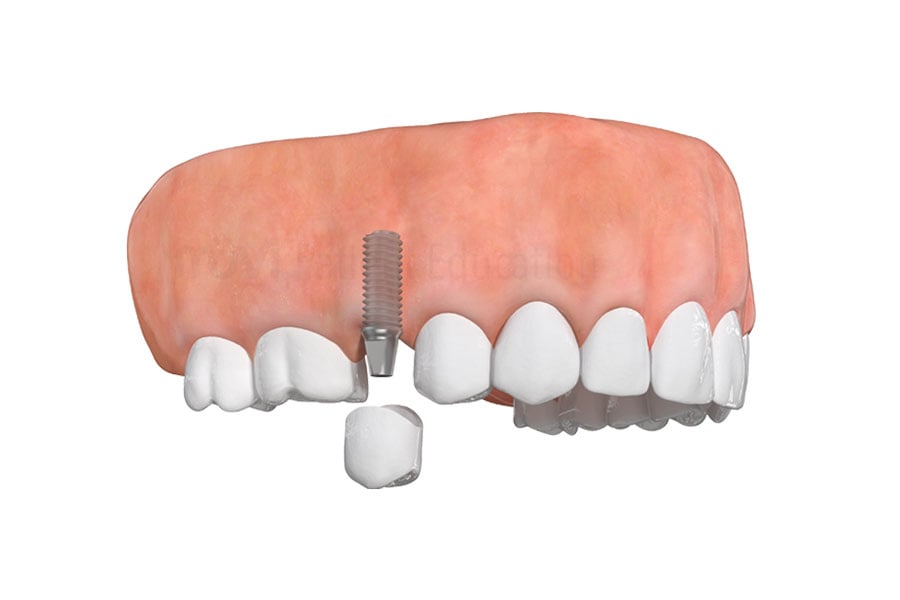 Schedule a dental consultation with Dr. Alina Huff, well-qualified cosmetic dentist in Hinsdale IL, to restore your teeth with dental implants near 60521. Dental Implants in Hinsdale, IL