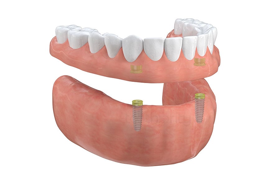Implant-supported overdenture at Hinsdale Dental Journey