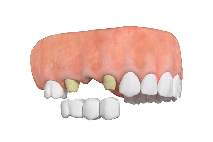 Are you embarrassed of your smile? Contact our state-of-the-art dental office in 60521 to see if you are a candidate for dental implants in Hinsdale, IL. Traditional Bridge in Hinsdale, IL