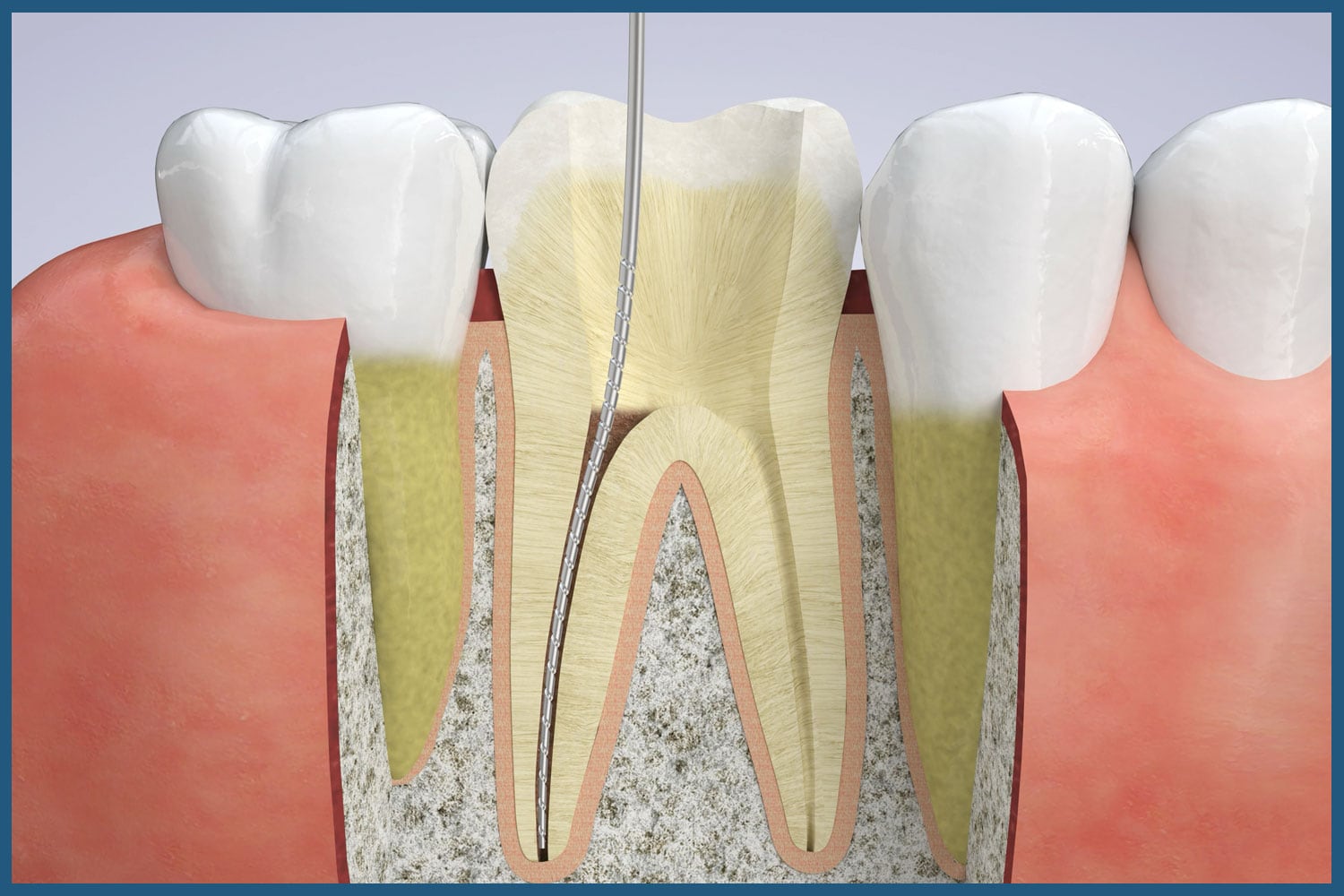 Stages of root canal therapy at Hinsdale Dental Journey